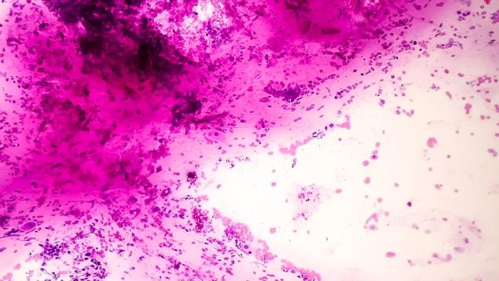 cancer pancreas
