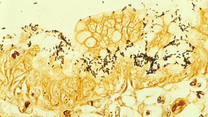 La infección por 'Helicobacter pylori' podría estar relacionada con hasta uno de cada cinco casos de cáncer colorrectal en el mundo, según un estudio helicobacter pylori